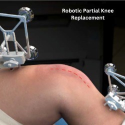Robotic partial knee replacement